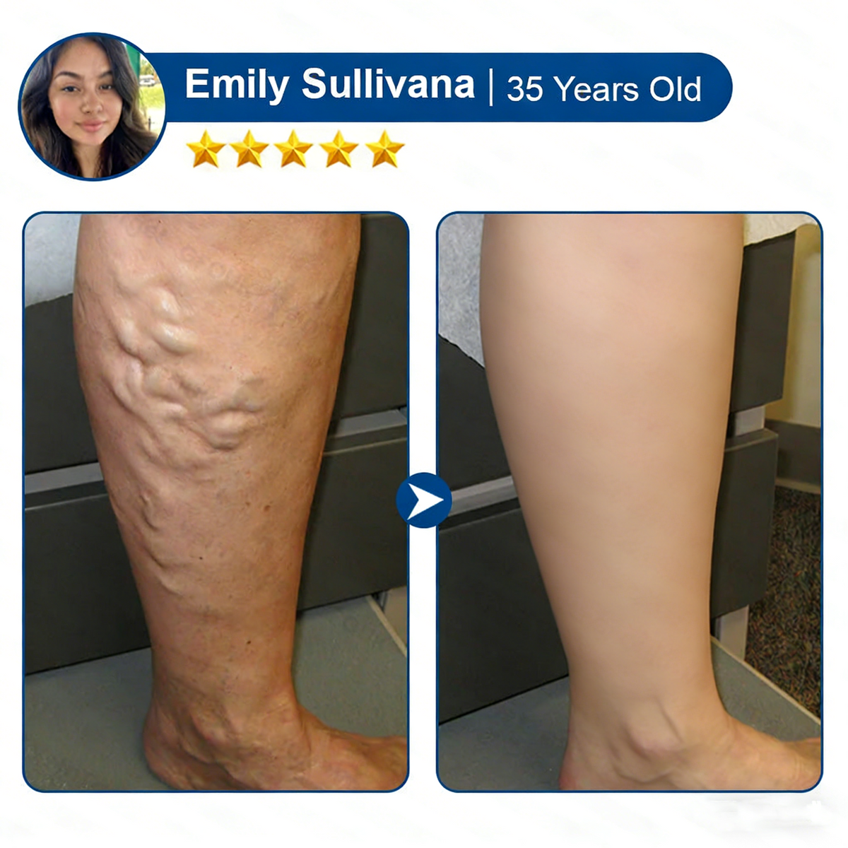 Vein ContourMicroneedle Patch with AdvancedDiosmin & Hesperidin Delivery 🌿 7-Day Visible Results for VaricoseVeins