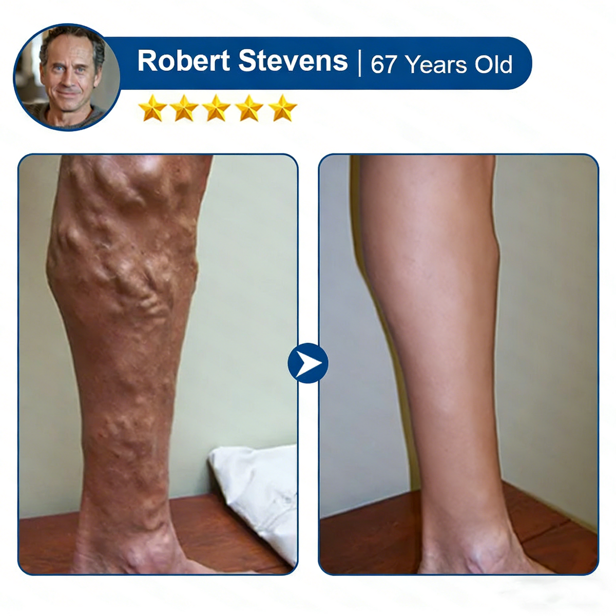 Vein ContourMicroneedle Patch with AdvancedDiosmin & Hesperidin Delivery 🌿 7-Day Visible Results for VaricoseVeins